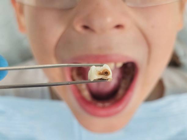 Best Dentist for Tooth Abscess  in Warsaw, MO